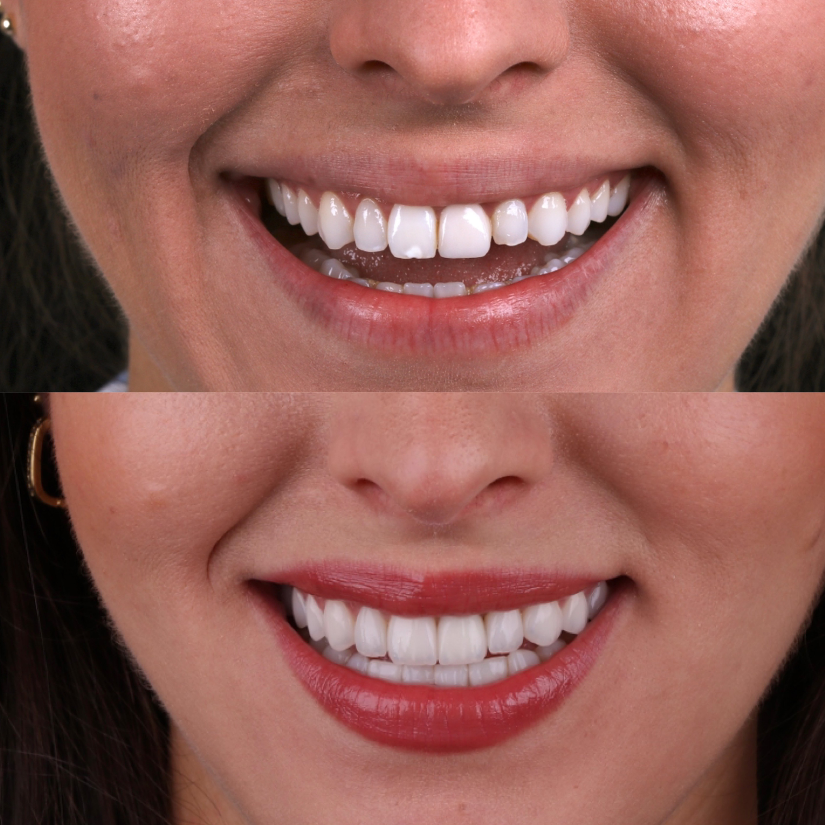 Antes e depois - Lentes de Contato Dental