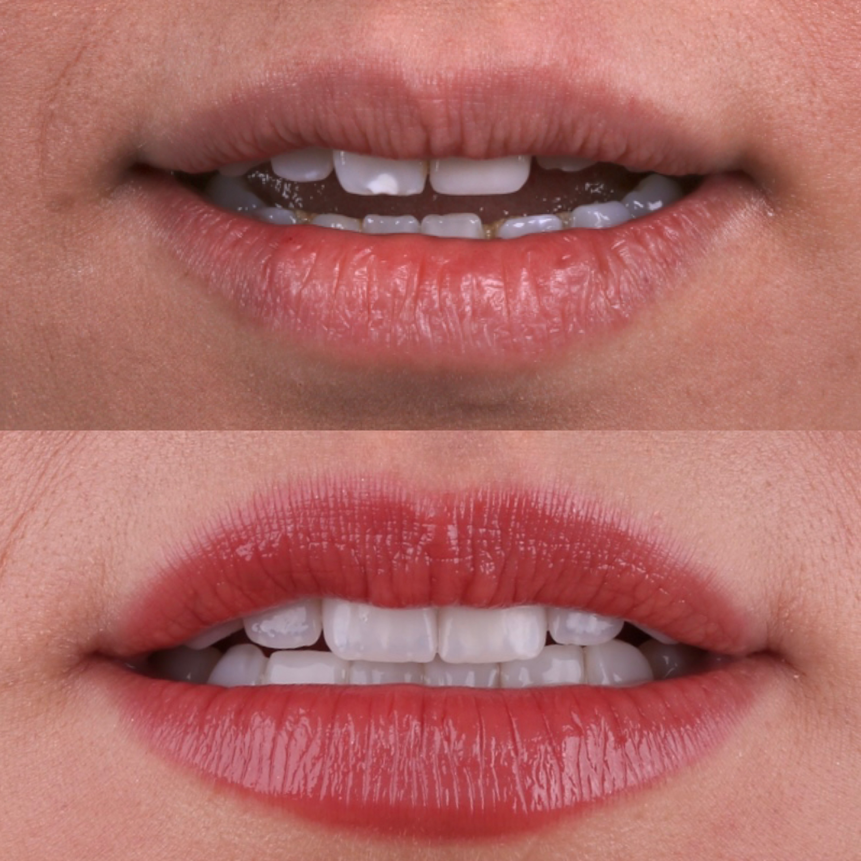 Antes e depois - Facetas em Porcelana