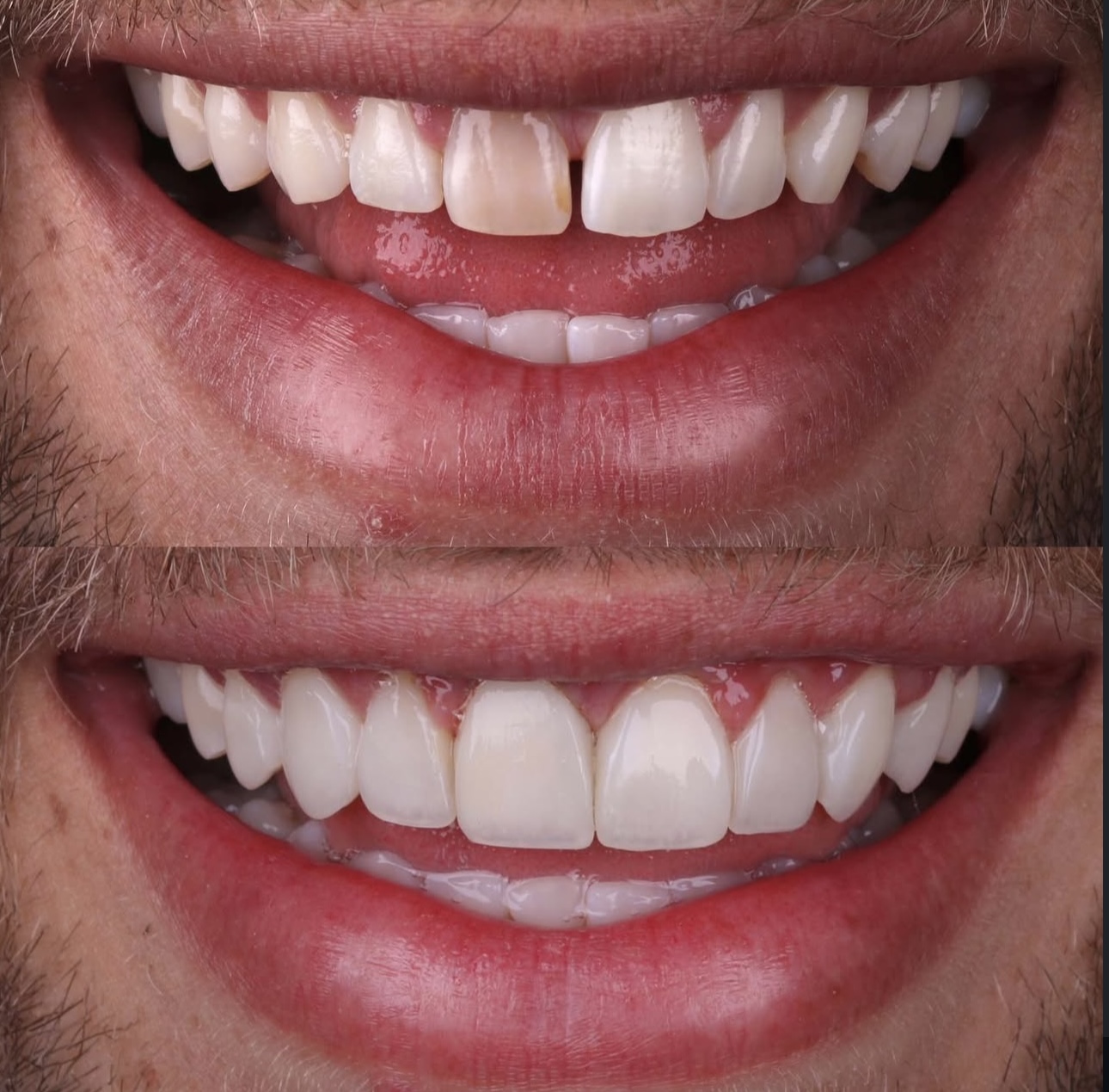 Antes e depois - Reabilitação Oral