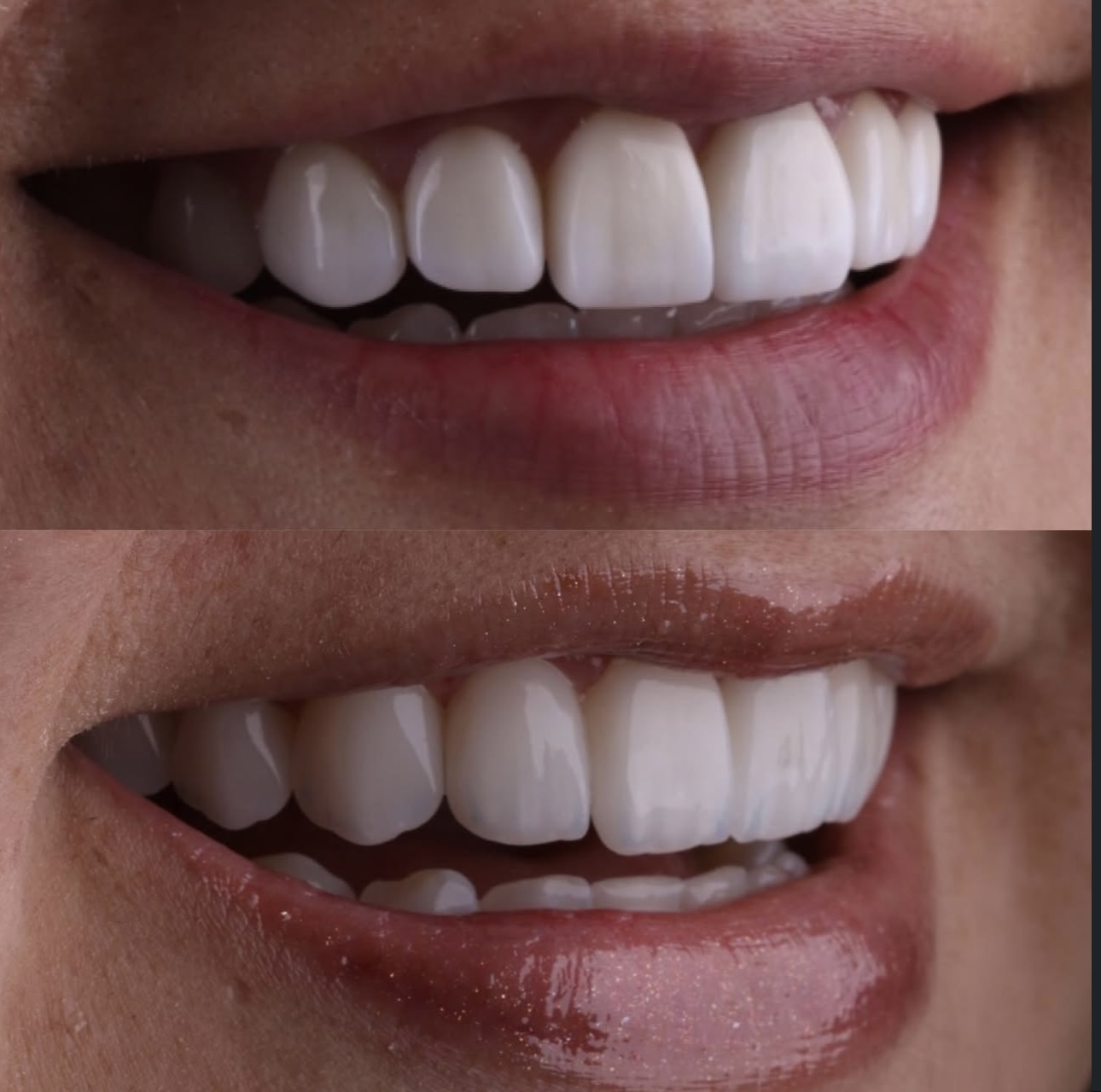 Antes e depois - Substituição de Lentes
