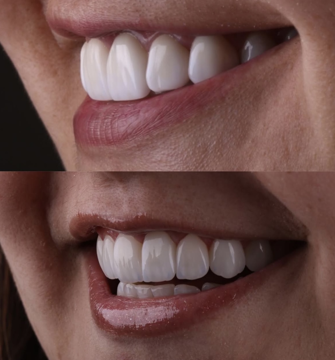 Antes e depois - Lentes de Contato